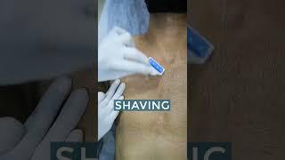 Laser Hair Removal Procedure at Sakhiya Skin Clinic | #shorts