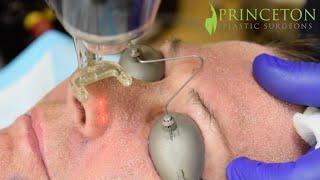 Facelift / Upper eye lid lift / CO2 laser || Dr. Hamawy || PrincetonMD