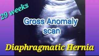Baby movement side and gender | Fundoposterior placenta |  29 weeks pregnant | Gross anomaly scan