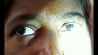 Relative Afferent Pupillary Defect (RAPD)