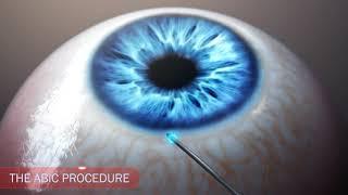 iTrack minimally invasive glaucoma procedure - animated video