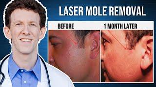 Laser Mole Removal | Live Procedure