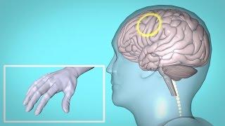 Repetitive Transcranial Magnetic Stimulation (rTMS) and Hand Therapy