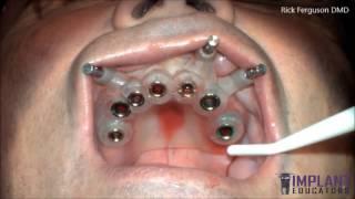 Live Guided Surgery - 7 Dental Implants in 40 Minutes -Full Video