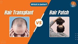 Hair Transplant or Patch - Which Is Better And Why? | Dr Alok Sahoo | Alloroots