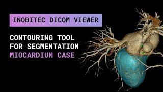 Contouring Tool for segmentation in Inobitec DICOM Viewer Pro. Miocardium case