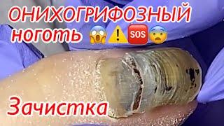 ОНИХОГРИФОЗНЫЙ ноготь️ • Зачистка