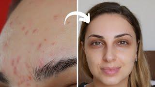 HYPERPIGMENTATION (Dark Spots) Treatment  This is How to Remove The ACNE MARKS!