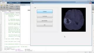 Brain tumor segmentation Convolutional neural network matlab projects