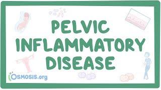 Pelvic inflammatory disease - causes, symptoms, diagnosis, treatment, pathology