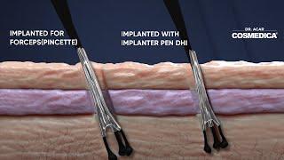 Dhi Micro Sapphire vs Fue Cosmedica Hair Transplant Dr. Acar