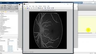 Retinal Disease using matlab code |ieee matlab image processing projects at bangalore