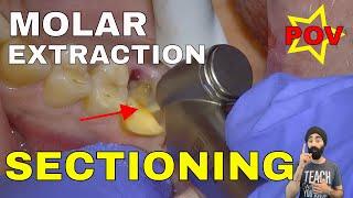 CLINICAL TUTORIAL: Upper Molar EXTRACTION with Electric Handpiece Section and Elevate FLAPLESS