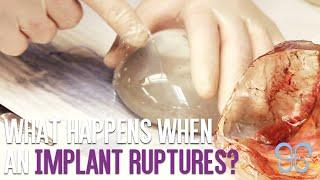 What If A Saline Implant Ruptures? | Brown Plastic Surgery