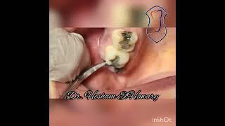 flapless surgical extraction of RR of upper right third molar using Cryer's elevator