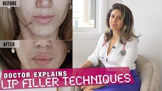 Which Lip Filler Technique? 5 Case Studies for BEST RESULTS | Doctor Explains 