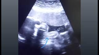 Anterior placenta with 28 weeks baby movements, gender & 3VCord | 8 weeks pregnancy with heartbeat