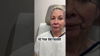 20 Years Taken Off! Facelift on a 62 Year Old 