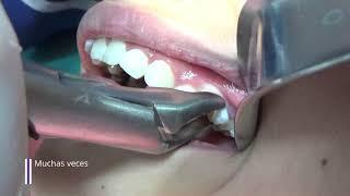 Extracción dental en niños/Extracción de dientes temporales