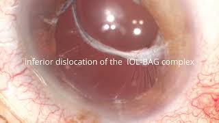 intrascleral doble flange fixation in subluxed IOL/capsular bag complex