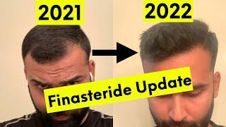 Finasteride 16 Months Update | Hair Regrowth | Side Effects | Hair Vigyan