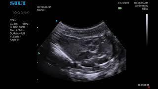 Snake Ultrasound Heart Scan - Python Echocardiography