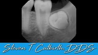 Extraction of Impacted Wisdom Teeth - Dental Minute with Steven T. Cutbirth, DDS