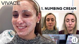 Vivace RF Microneedling | Patient Review