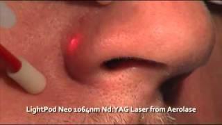 Facial Vessel Removal - The LightPod Neo 1064nm Laser by Aerolase