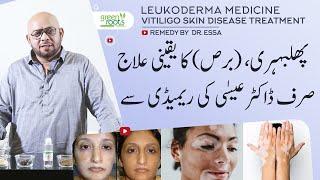 vitiligo skin disease treatment the easy way | Burs Easy Home remedy by Dr Essa | phulbehri ka ilaj