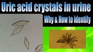 Uric acid crystals in urine (Why & How to identify)