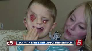 Boy With Rare Birth Defect Inspires His Mother
