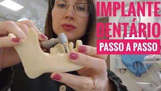 Implante Dentário Passo a Passo l Dra. Danielle Sales