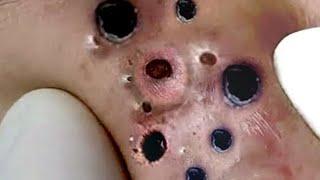 thuy truong 001 #blackheads