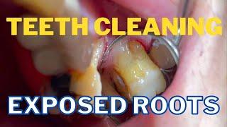 Dental Cleaning  Large Hidden Tartar in the Back Teeth 