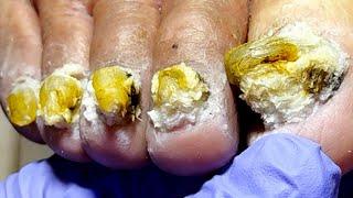 The Onychomycosis Has Spread To All Nails, So Trim Them Carefully【Xue Yidao】