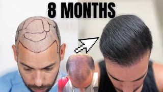 8 Month Hair Transplant Update 4000 Grafts 9K Total