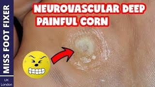 Neurovascular DEEP PAINFUL Corn Removal *** Full Thickness Corn *** BY MISS FOOT FIXER