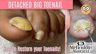 How To Pedicure Transformation for Men on Detached Toenails