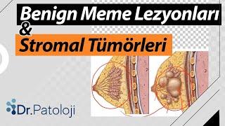 Benign Meme Lezyonları ve Stromal Tümörleri