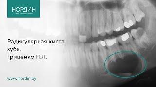 Киста зуба: что делать с радикулярной кистой зуба