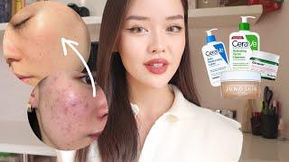 HOW I GOT RID OF MY ACNE + unsponsored skincare routine 