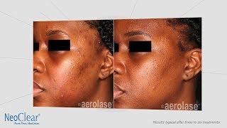 NeoClear by Aerolase Laser Acne Therapy