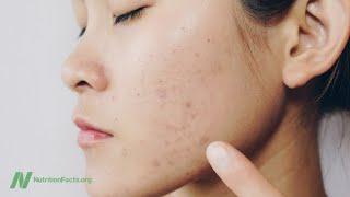 Saving Lives by Treating Acne with Diet