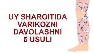 Varikozni Uy Sharoitida Davolashni 5 Usuli