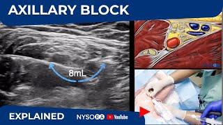 Ultrasound Guided Axillary Brachial Plexus Block NYSORA Regional Anesthesia