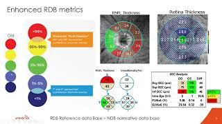 Introducing Optovue Solix by Visionix with Dr. Julie Rodman