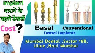 डेंटल इंप्लांट कौन सा करवाएं एवं खर्चा ? Which Dental implant is best for you and how much it cost .