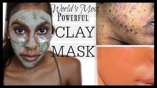 How I Get Rid of Acne in ONE DAY! | WORLD'S MOST POWERFUL MUD FACIAL|