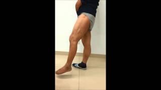 Obturator Nerve Transfer to the Branch of the Tibial Nerve: Video 1